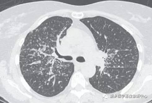 看到肺内多发结节一定要想到的9种病变