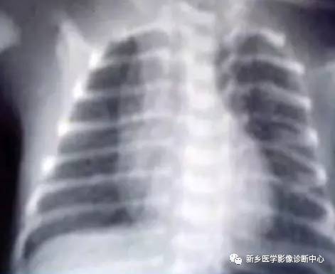 看到肺内多发结节一定要想到的9种病变