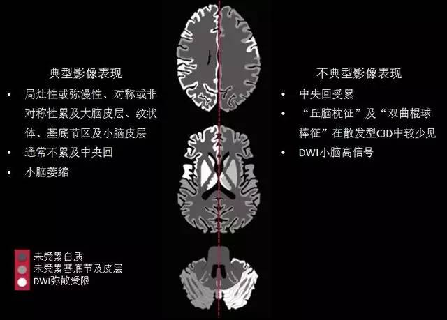 最全CJD影像表现及鉴别诊断汇总