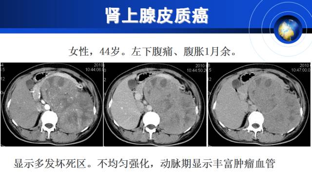 【PPT】肾上腺少见疾病的影像诊断