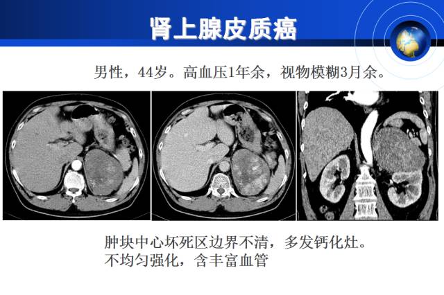 【PPT】肾上腺少见疾病的影像诊断