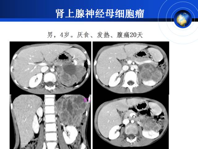 【PPT】肾上腺少见疾病的影像诊断