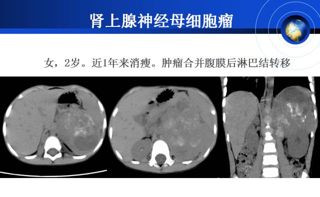 【PPT】肾上腺少见疾病的影像诊断