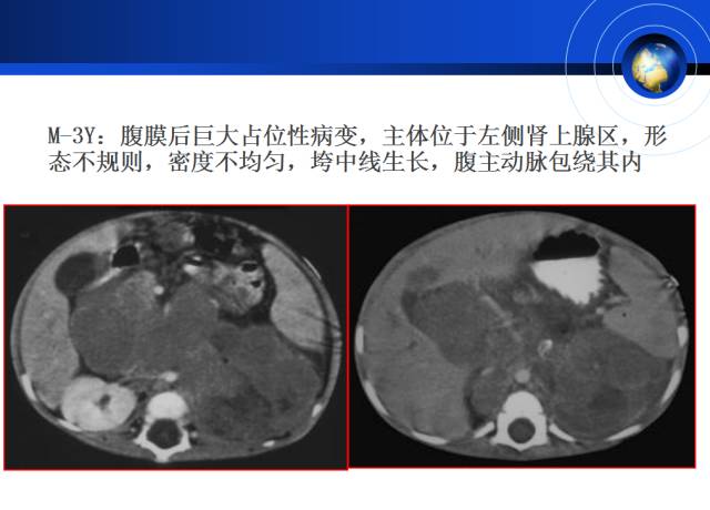 【PPT】肾上腺少见疾病的影像诊断