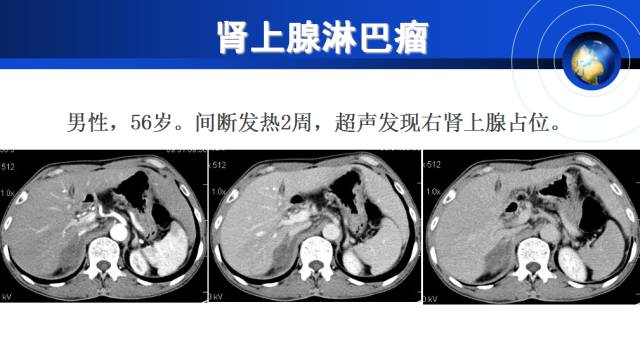 【PPT】肾上腺少见疾病的影像诊断