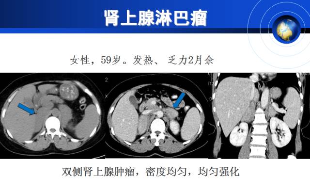 【PPT】肾上腺少见疾病的影像诊断