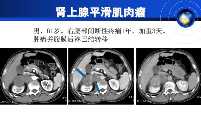 【PPT】肾上腺少见疾病的影像诊断