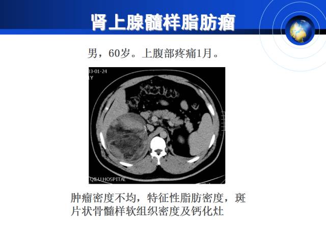 【PPT】肾上腺少见疾病的影像诊断