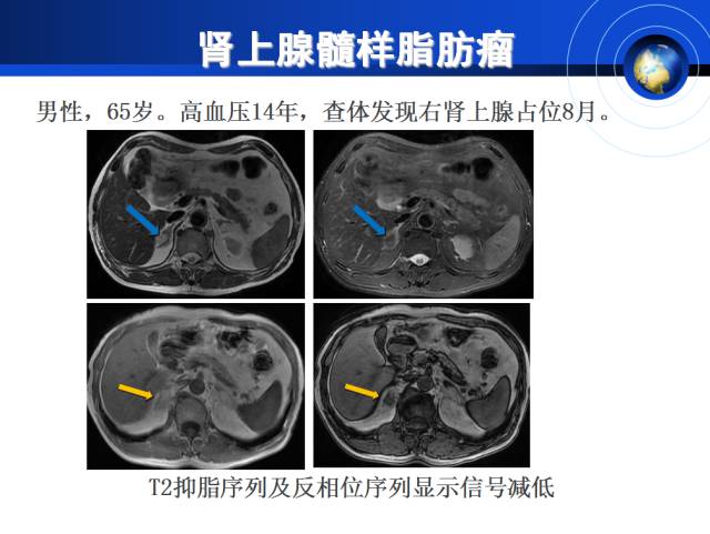 【PPT】肾上腺少见疾病的影像诊断