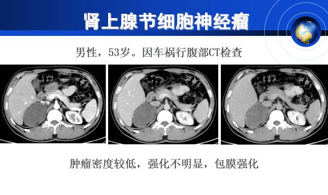 【PPT】肾上腺少见疾病的影像诊断