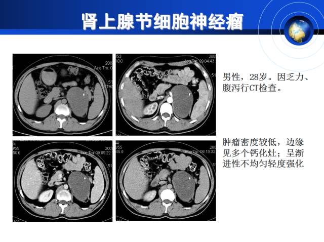 【PPT】肾上腺少见疾病的影像诊断
