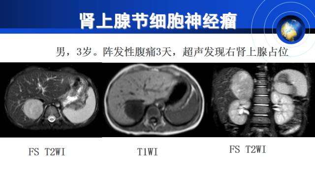 【PPT】肾上腺少见疾病的影像诊断