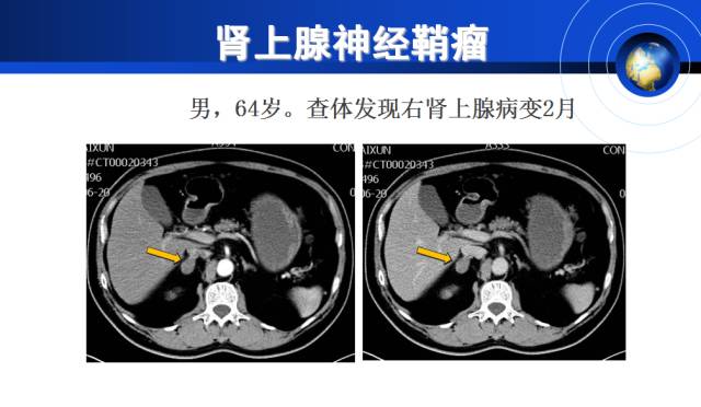 【PPT】肾上腺少见疾病的影像诊断