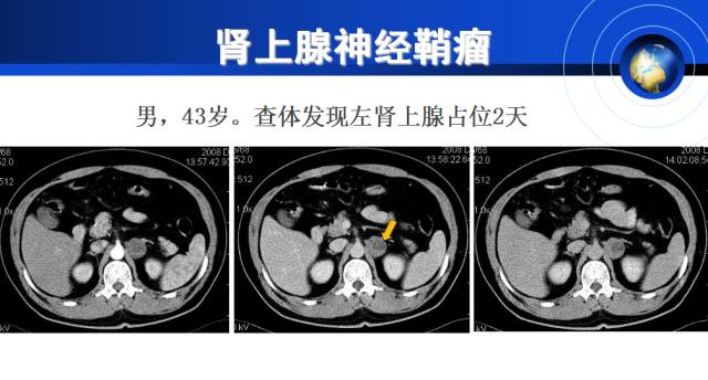 【PPT】肾上腺少见疾病的影像诊断