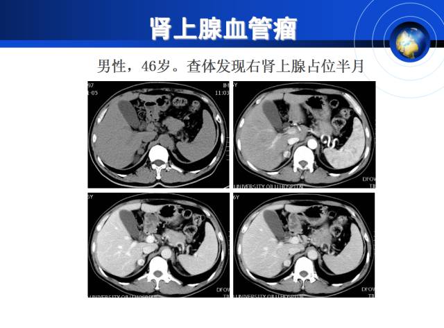 【PPT】肾上腺少见疾病的影像诊断
