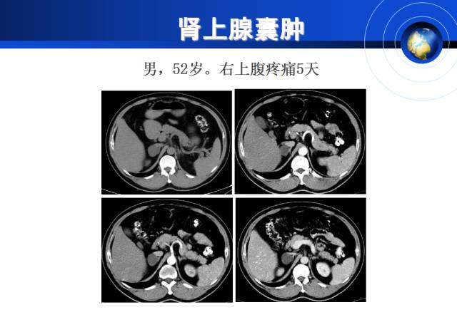 【PPT】肾上腺少见疾病的影像诊断