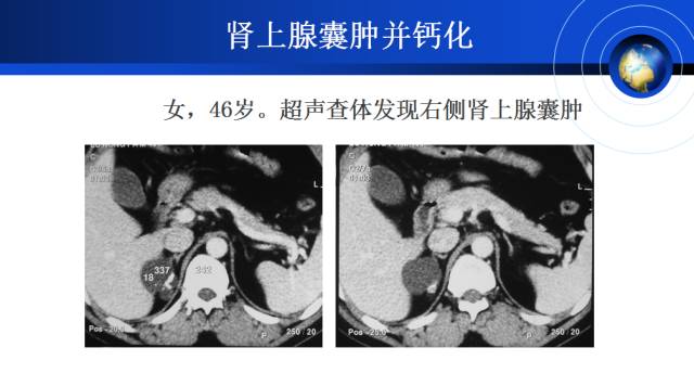 【PPT】肾上腺少见疾病的影像诊断