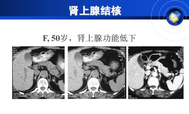 【PPT】肾上腺少见疾病的影像诊断