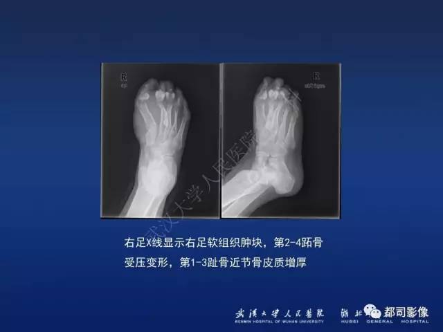 【PPT】肌骨纤维瘤病的影像学表现