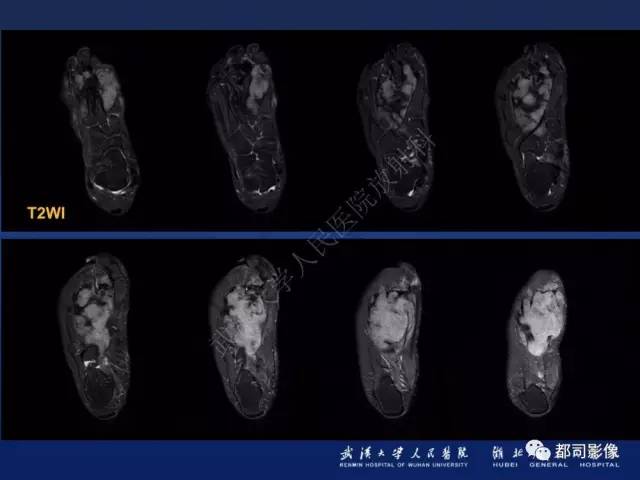 【PPT】肌骨纤维瘤病的影像学表现