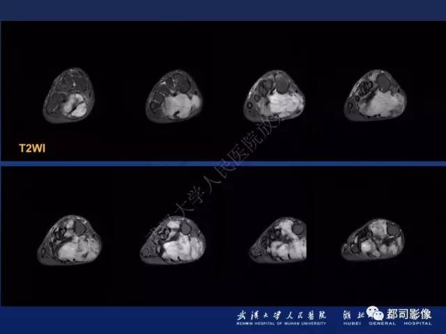 【PPT】肌骨纤维瘤病的影像学表现