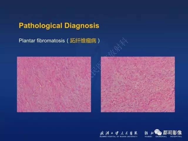 【PPT】肌骨纤维瘤病的影像学表现
