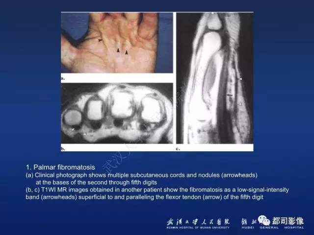 【PPT】肌骨纤维瘤病的影像学表现