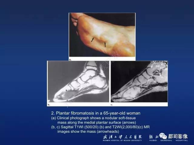 【PPT】肌骨纤维瘤病的影像学表现