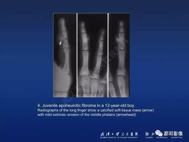 【PPT】肌骨纤维瘤病的影像学表现