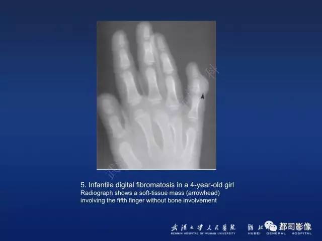 【PPT】肌骨纤维瘤病的影像学表现