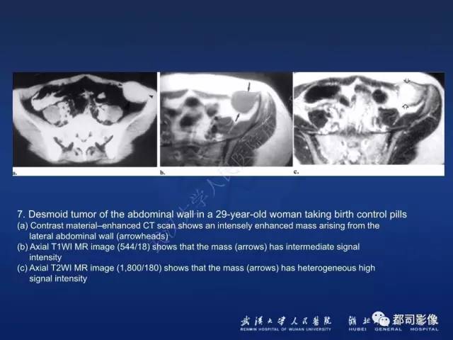 【PPT】肌骨纤维瘤病的影像学表现