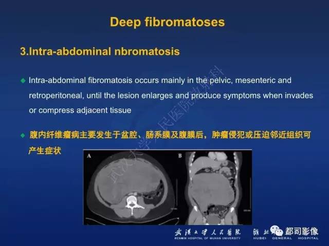 【PPT】肌骨纤维瘤病的影像学表现