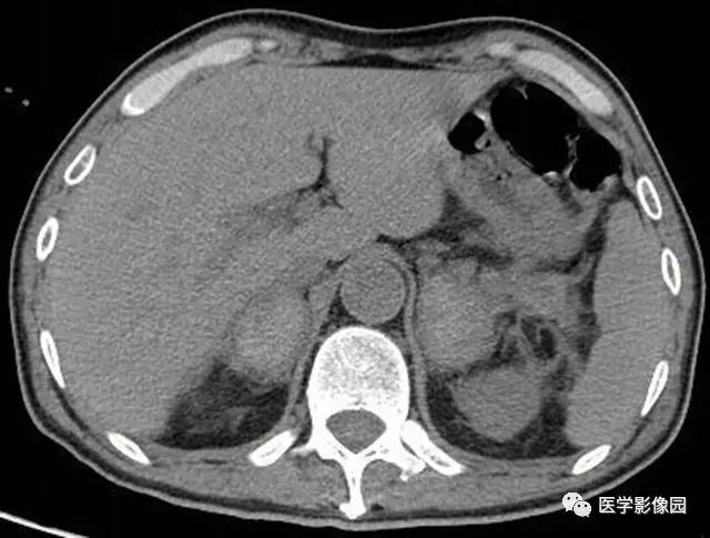 【病例】凝血功能障碍所致双侧肾上腺出血1例CT