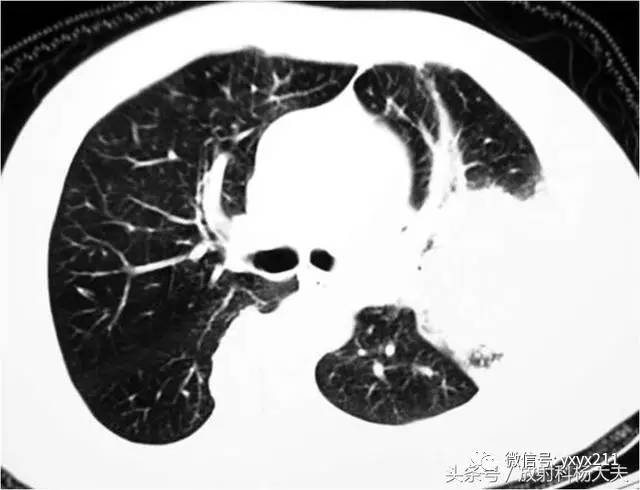 【病例】肺囊虫肺炎(卡氏肺孢子虫)1例CT