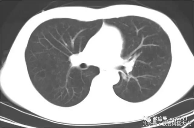 【病例】肺囊虫肺炎(卡氏肺孢子虫)1例CT