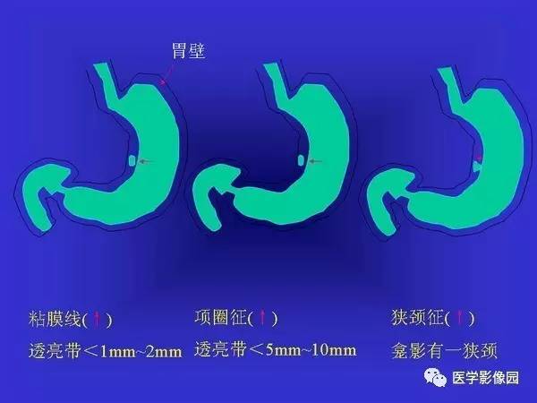 【PPT】胃十二指肠溃疡与胃癌的影像学表现