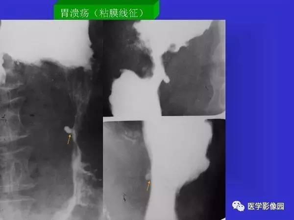 【PPT】胃十二指肠溃疡与胃癌的影像学表现
