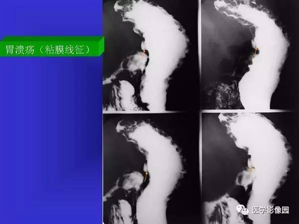 【PPT】胃十二指肠溃疡与胃癌的影像学表现