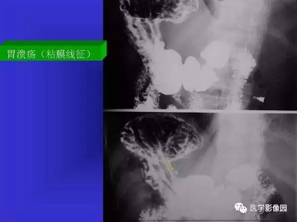 【PPT】胃十二指肠溃疡与胃癌的影像学表现