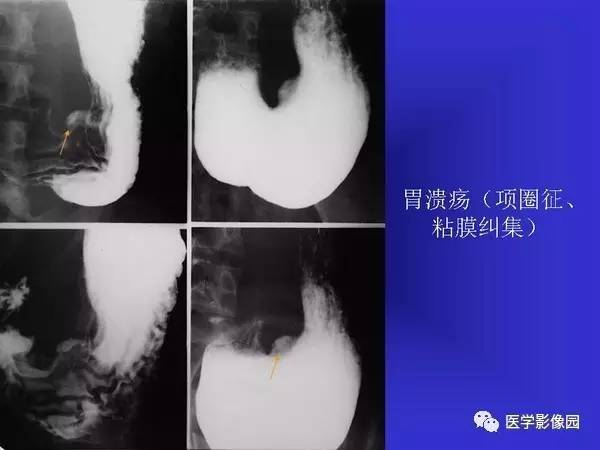 【PPT】胃十二指肠溃疡与胃癌的影像学表现