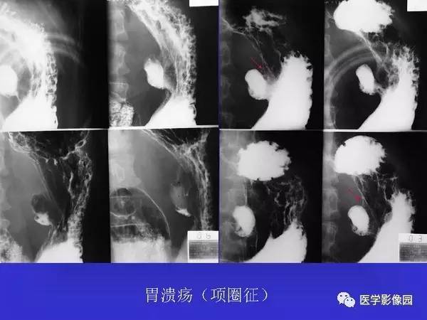 【PPT】胃十二指肠溃疡与胃癌的影像学表现