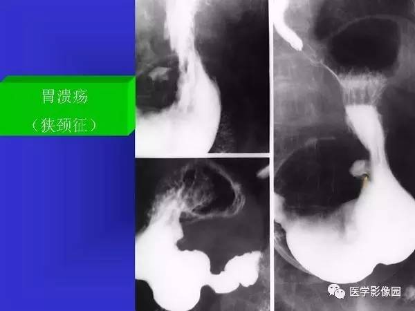 【PPT】胃十二指肠溃疡与胃癌的影像学表现