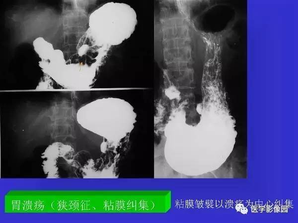 【PPT】胃十二指肠溃疡与胃癌的影像学表现