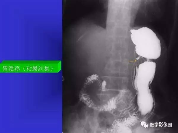 【PPT】胃十二指肠溃疡与胃癌的影像学表现