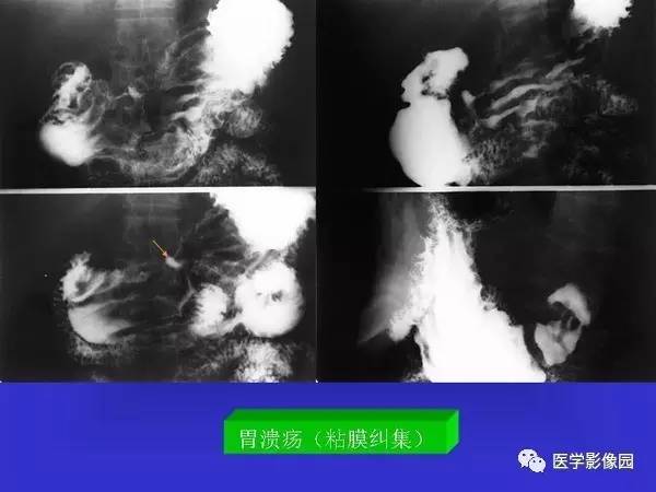 【PPT】胃十二指肠溃疡与胃癌的影像学表现
