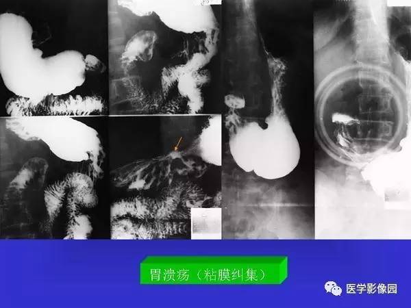 【PPT】胃十二指肠溃疡与胃癌的影像学表现