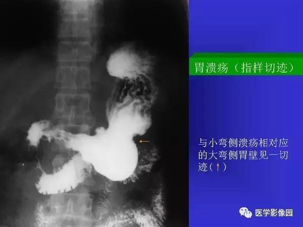 【PPT】胃十二指肠溃疡与胃癌的影像学表现