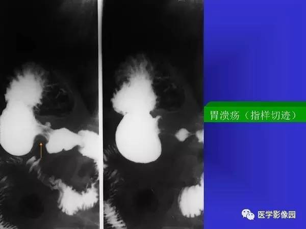 【PPT】胃十二指肠溃疡与胃癌的影像学表现