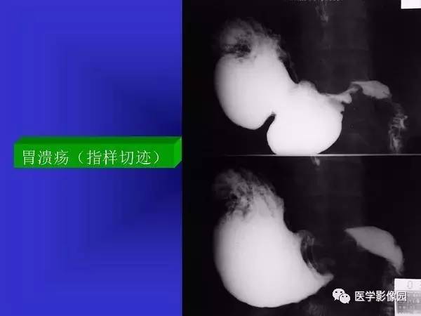 【PPT】胃十二指肠溃疡与胃癌的影像学表现