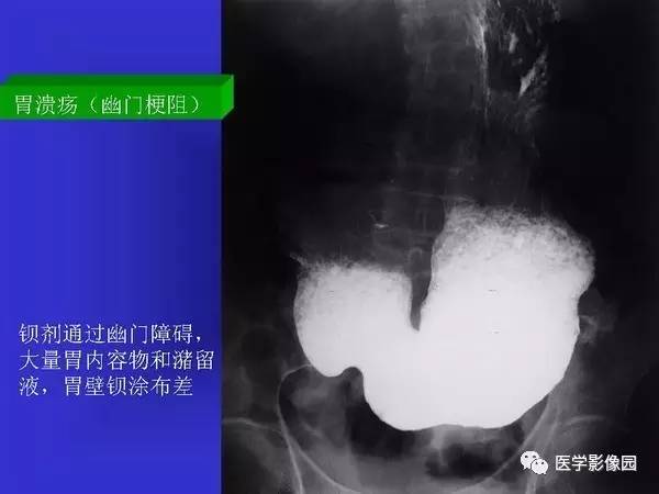 【PPT】胃十二指肠溃疡与胃癌的影像学表现
